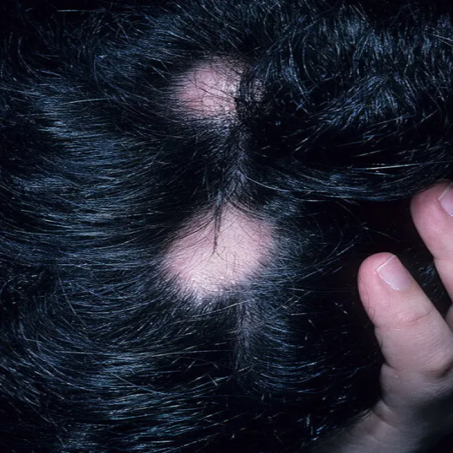 Przerzedzone włosy na przedziałku