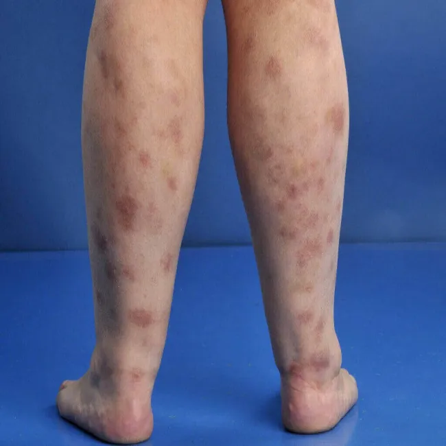 Przyłuszczyca na nogach