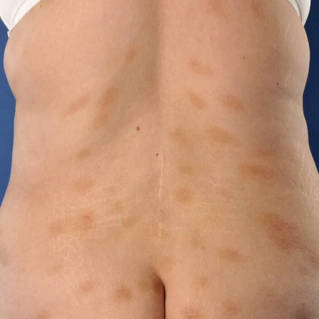 Przyłuszczyca na plecach