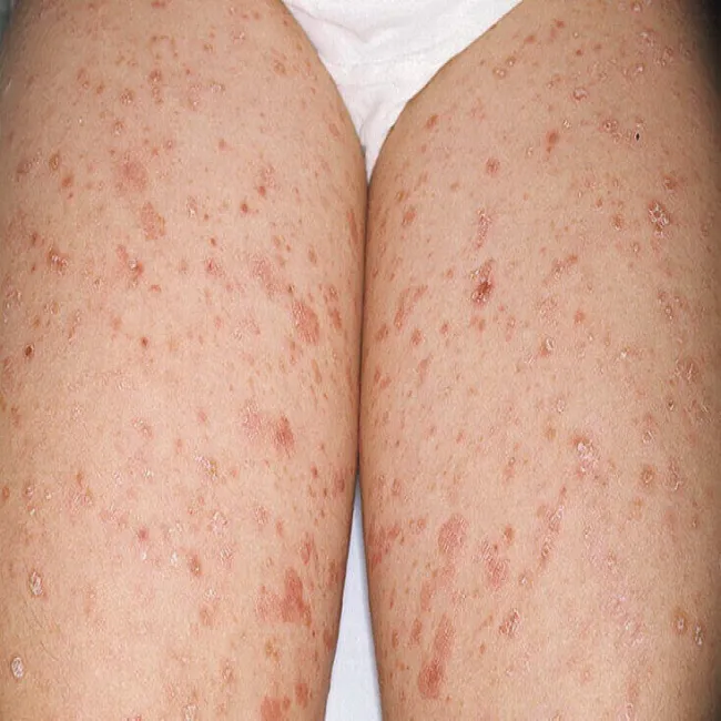 Przyłuszczyca na udach