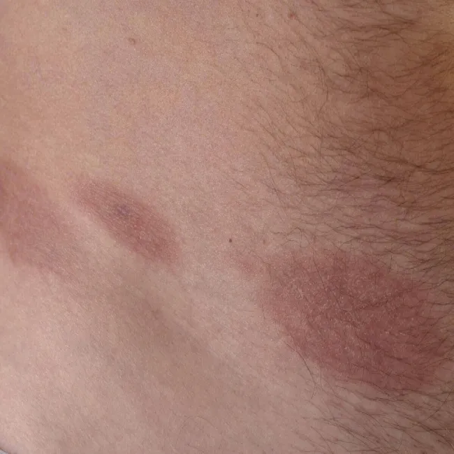 Przyłuszczyca plackowata wieloogniskowa 