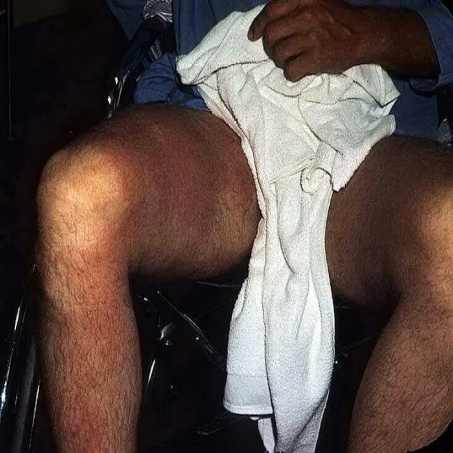 Róża choroba na udach