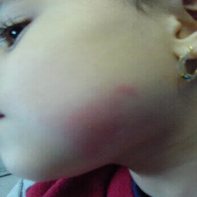 Róża choroba u dziecka