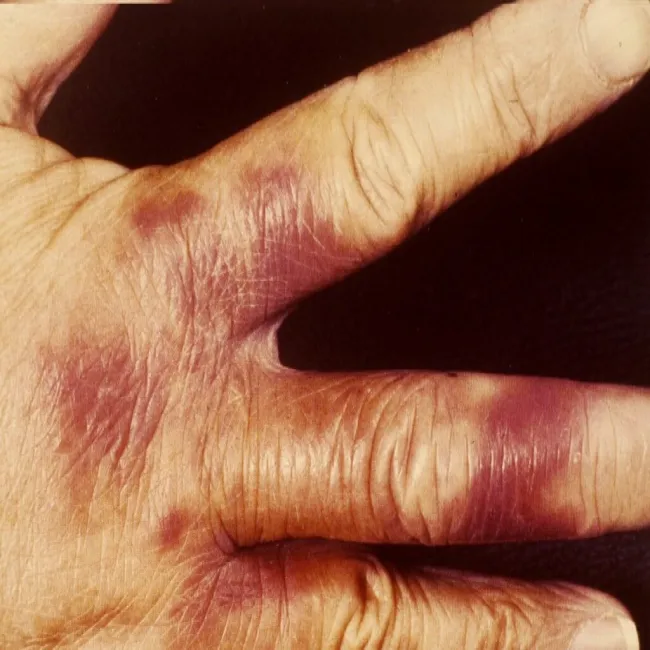 Różyca u ludzi zdjęcia