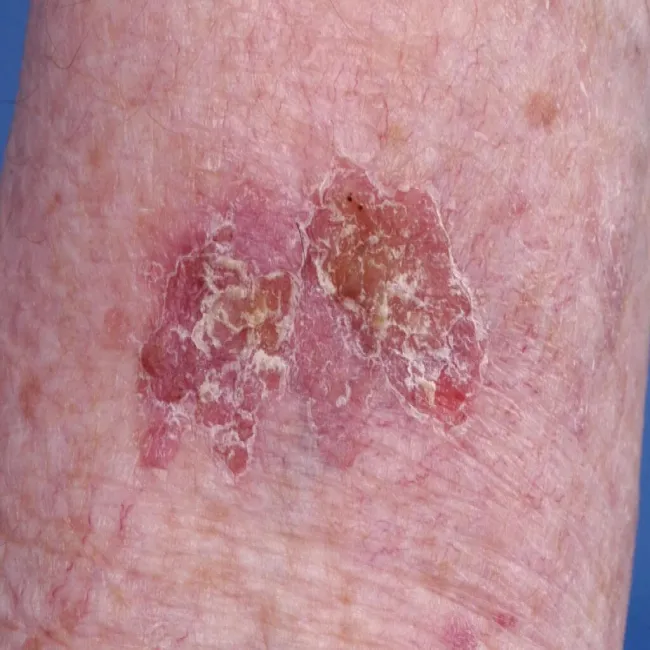 Rak kolczystokomórkowy śródnaskórkowy choroba Bowena