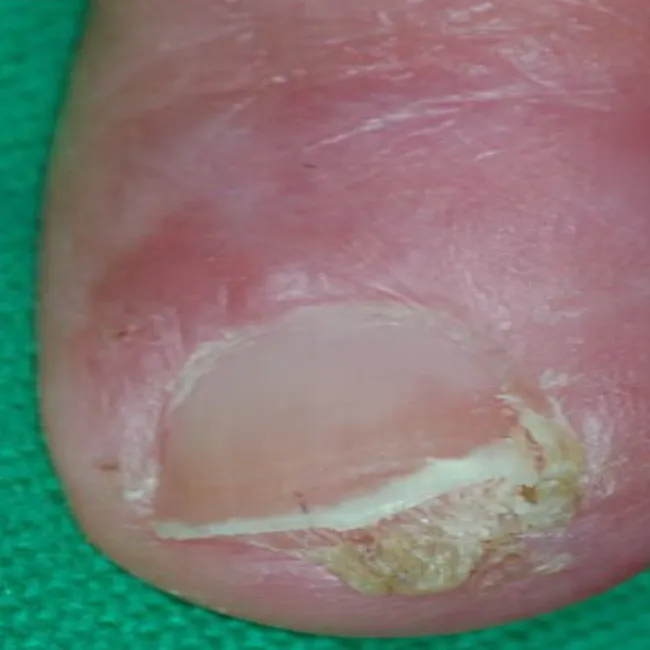 Rak paznokcia choroba Bowena