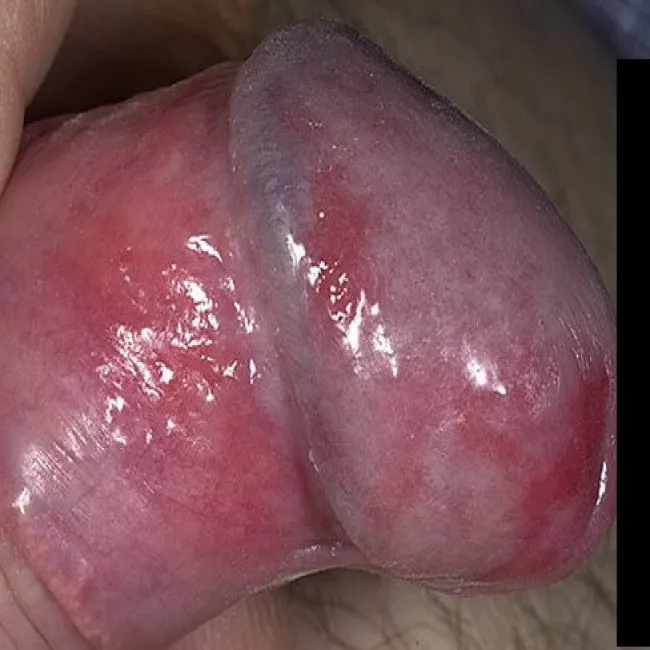 Rak penisa choroba Bowena