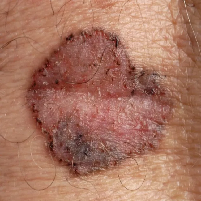 Rak podstawnokomórkowy barwnikowy zdjęcia