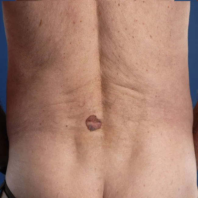 Rak podstawnokomórkowy barwnikowy