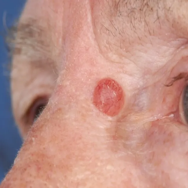 Rak podstawnokomórkowy guzkowy