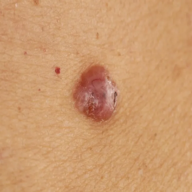 Rak podstawnokomórkowy skóry 