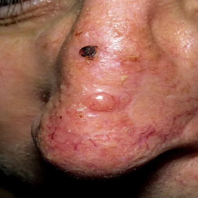 Rak podstawnokomórkowy torbielowaty