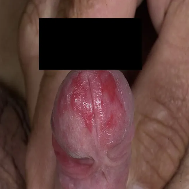 Rak prącia choroba Bowena