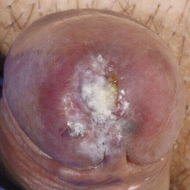 Rak prącia mięsak Kaposiego 