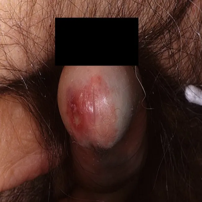 Rak przedinwazyjny prącia 