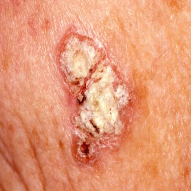 Rak skóry choroba Bowena
