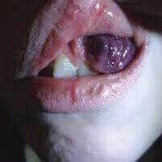 Rak dziąsła mięsak Kaposiego 