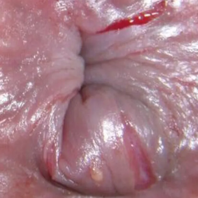 Rana koło odbytu szczelina odbytu 