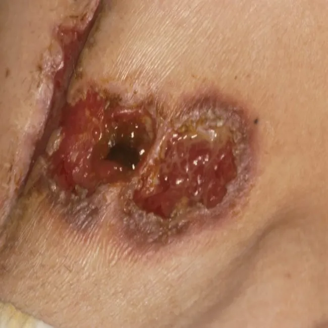 Rana wokół stomii piodermia zgorzelinowa