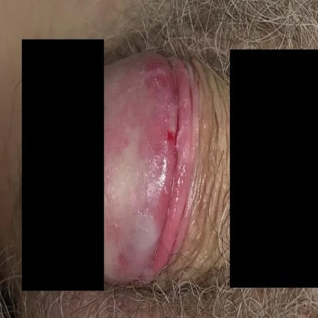 Rany na napletku zapalenie napletka