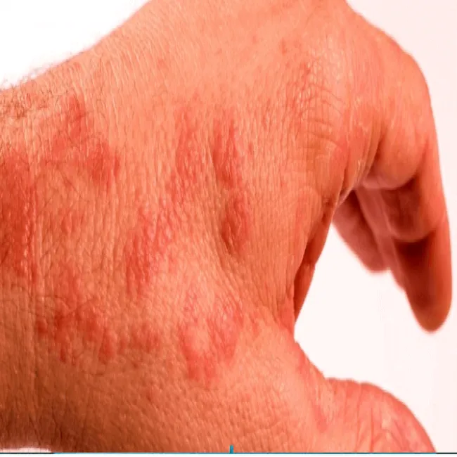 Reakcją opóźniona na kontakt z lateksem