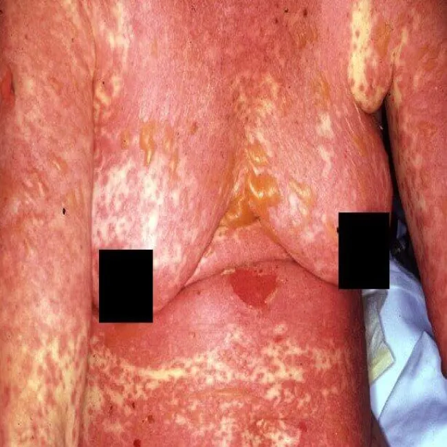 Reakcja na leki sterydowe toksyczna nekroliza naskórka