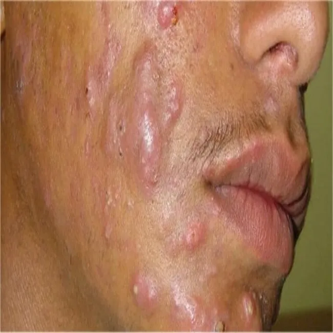 Rodzaje trądziku - trądzik skupiony 