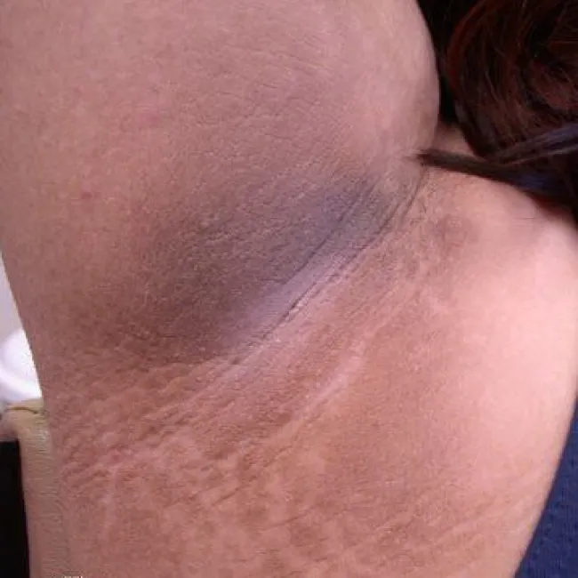 Rogowacenie ciemne pod pachami