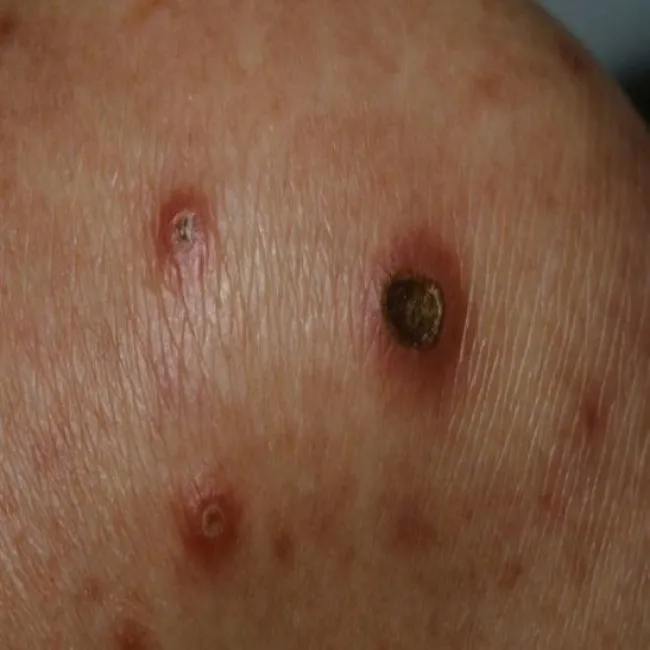 Rogowacenie mieszkowe i okołomieszkowe wnikające do skóry choroba Kyrle