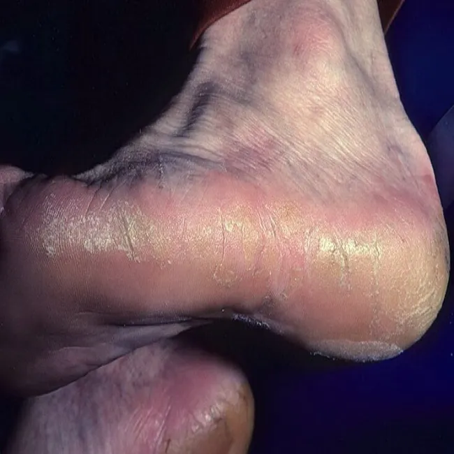 Rogowacenie podeszwowe