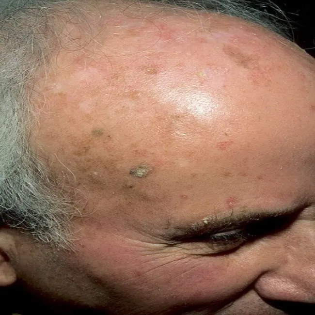 Rogowacenie słoneczne na czole