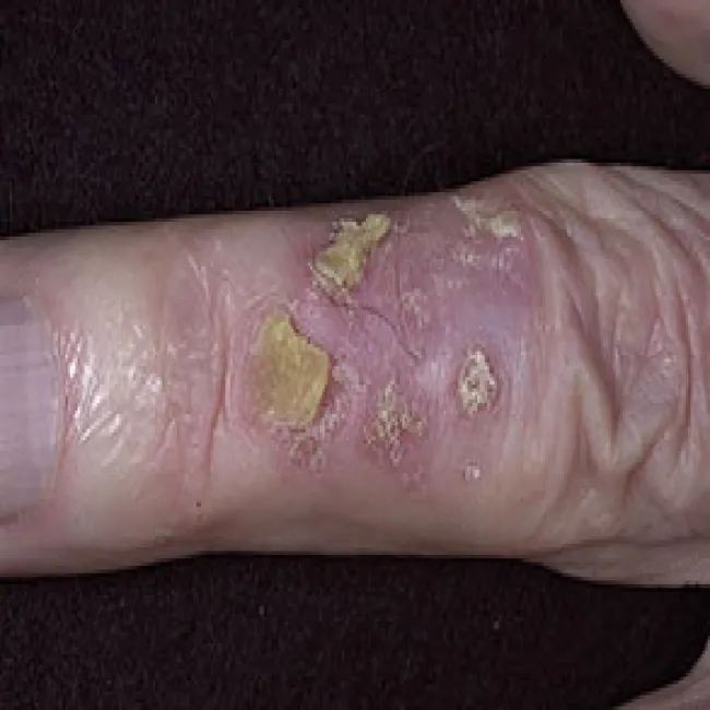 Rogowacenie słoneczne na palcu