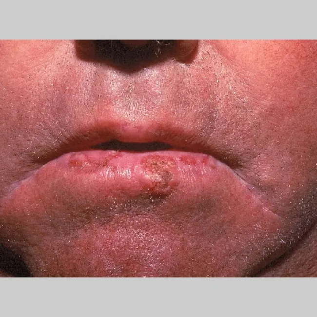 Rogowacenie słoneczne na ustach
