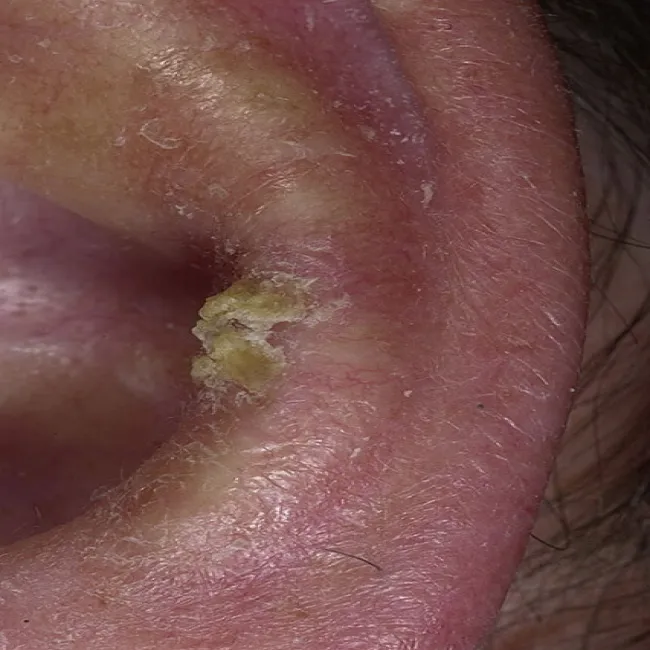 Rogowacenie słoneczne w uchu