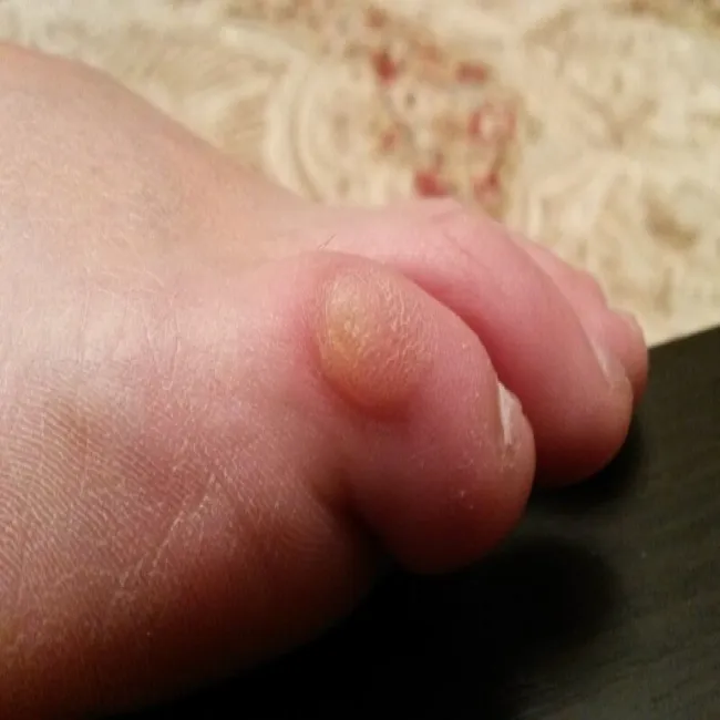 Rogowacenie skóry na małym palcu