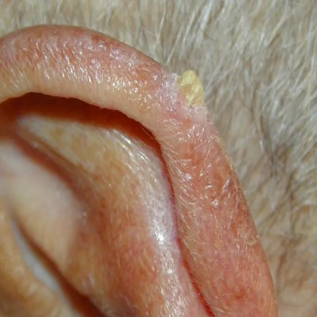 Rogowacenie starcze na uchu