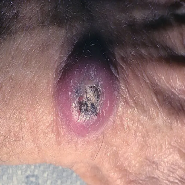 Rogowiak kolczystokomórkowy duża narośl na dłoni