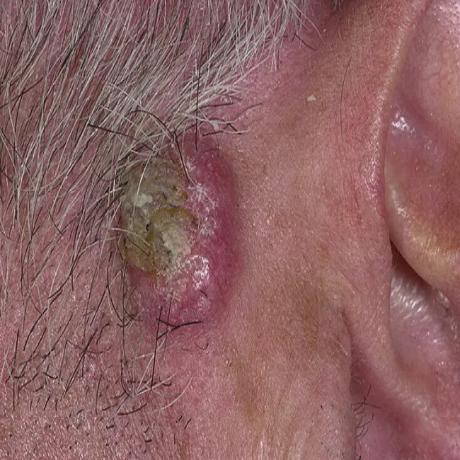 Rogowiak kolczystokomórkowy guz za uchem