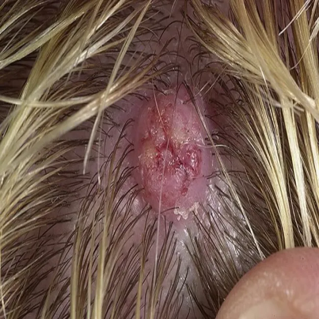 Rogowiak kolczystokomórkowy guzek na skórze głowy