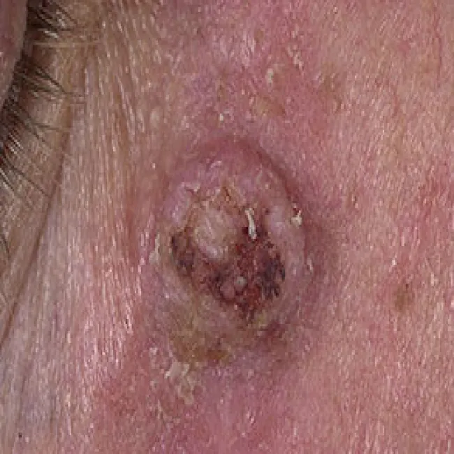 Rogowiak kolczystokomórkowy pod okiem