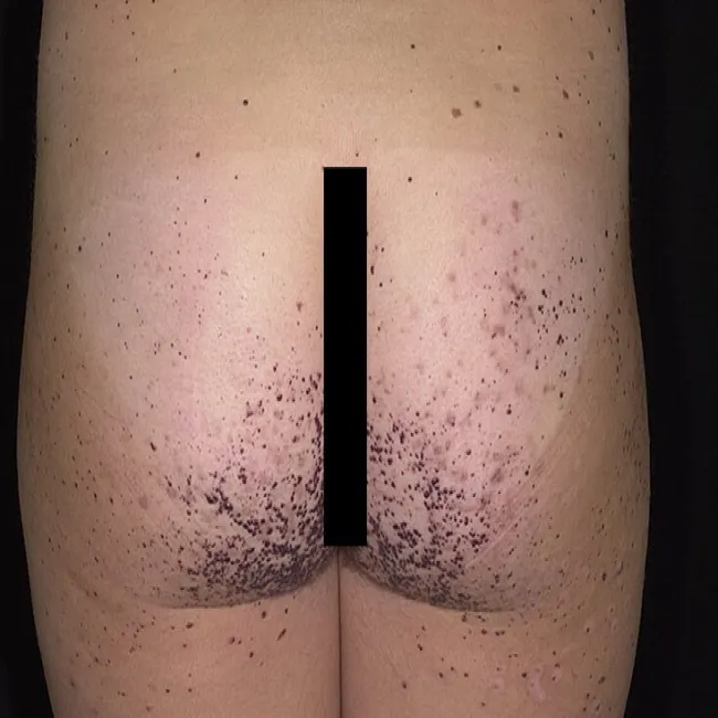 Rogowiec krwawy na pośladkach