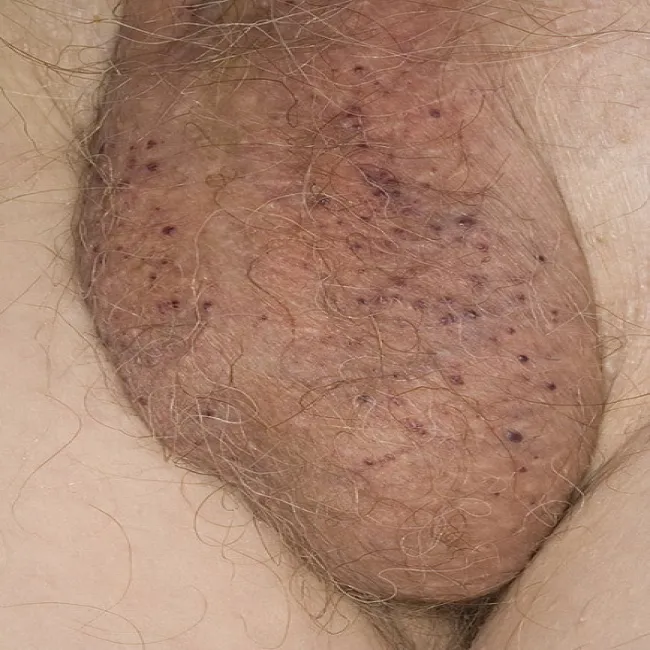 Rogowiec krwawy na skórze moszny