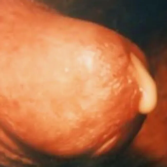 Ropna wydzielina z penisa choroba rzeżączka