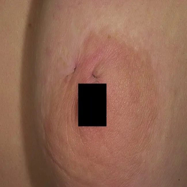 Ropne zapalenie apokrynowych gruczołów potowych na piersi