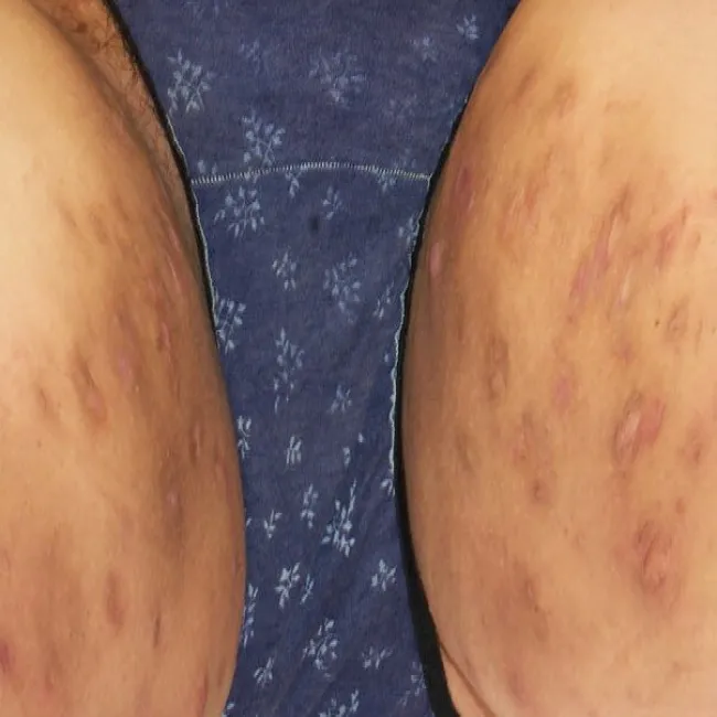 Ropne zapalenie apokrynowych gruczołów potowych na udach