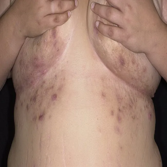 Ropne zapalenie apokrynowych gruczołów potowych pod piersiami