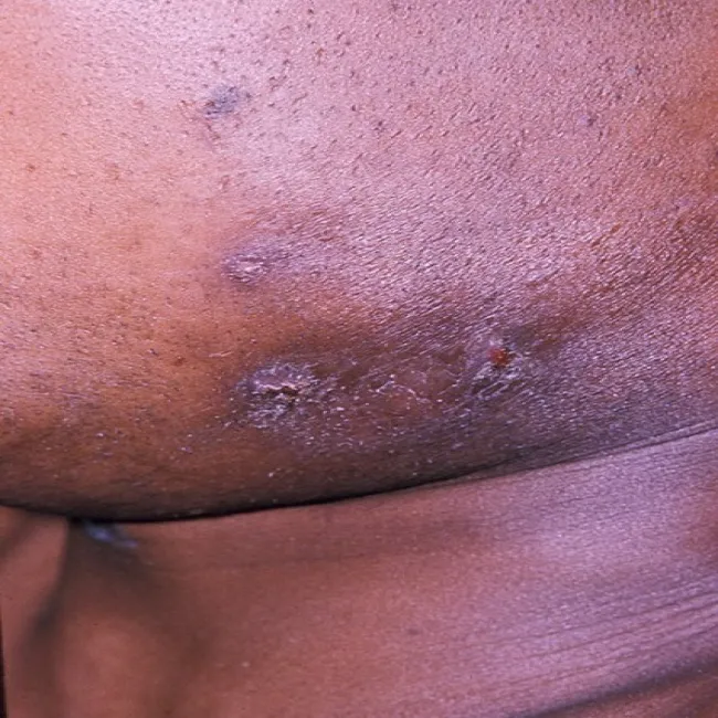 Ropne zmiany na skórze choroba promienica