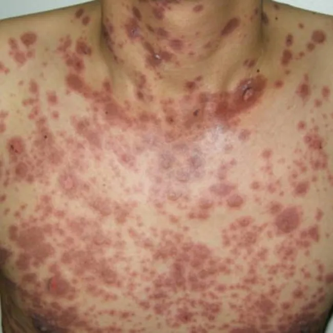 Rozlana wysypka plamisto-grudkowa w przebiegu martwicy toksyczno-rozpływnej naskórka