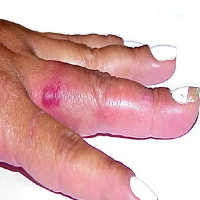 Rumień na palcu różyca