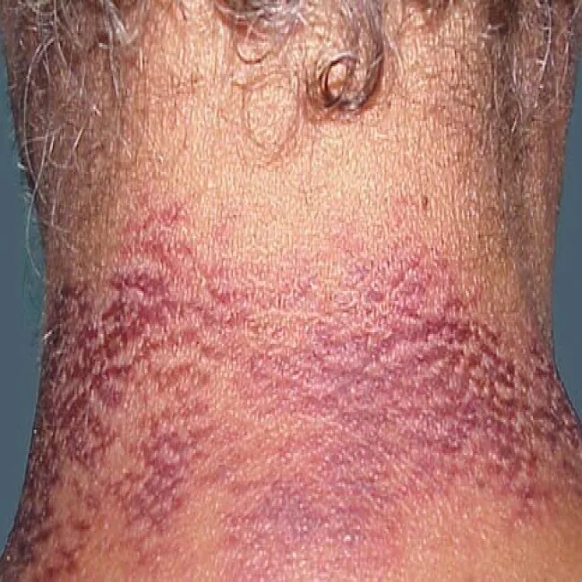 Rumień na szyi pelagra